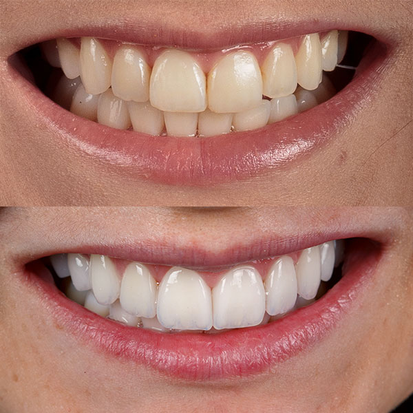 Dr Bruno Rattmann Lentes de Contato Dental Antes e Depois