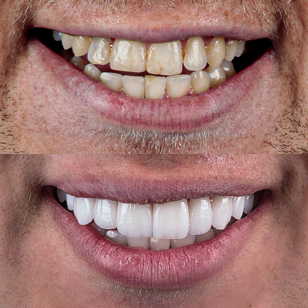 Dr Bruno Rattmann Lentes de Contato Dental Antes e Depois